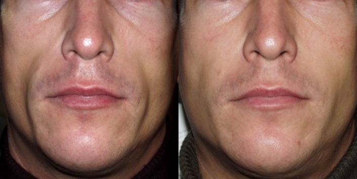 Masculinización facial en Valencia