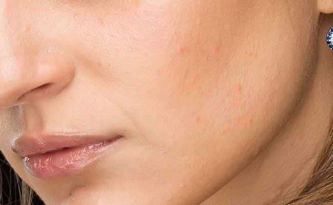 Tratamiento de luminosidad facial - Antés