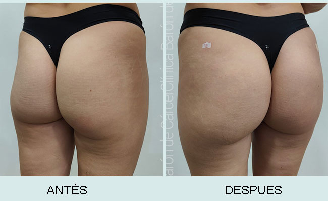 Aumento de glúteo con acido hialurónico Deneb