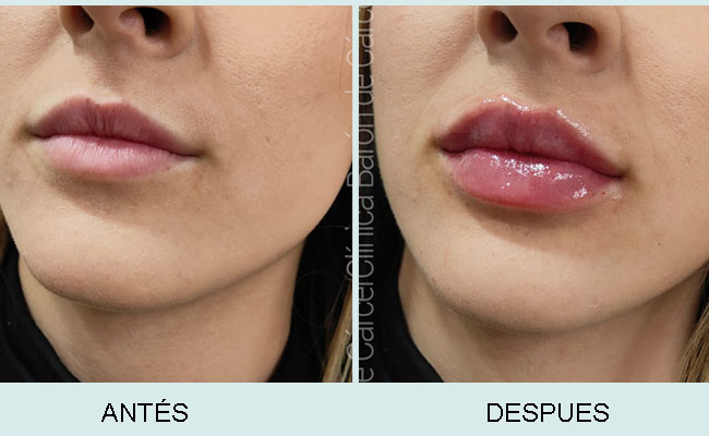 Aumento de labios en CBDC, Valencia